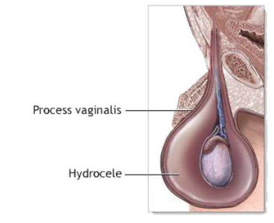 Гидроцеле яичка. Водянка яичка гидроцеле. Водянка оболочек яичка.