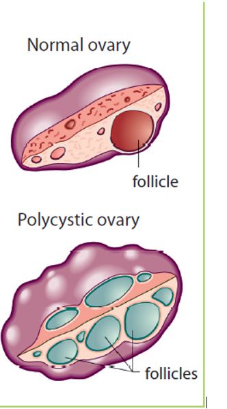 Polycystic ovary syndrome: what it means for your long-term health