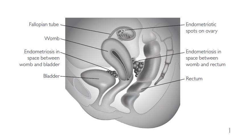 Endometriosis