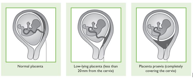Placenta praevia, placenta accreta and vasa praevia