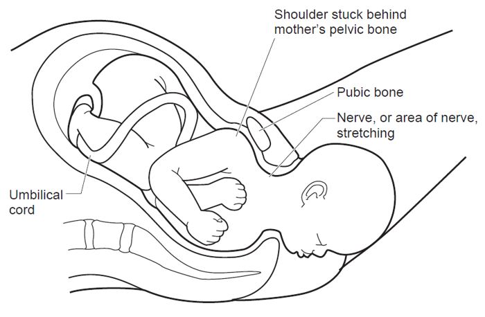 Shoulder dystocia