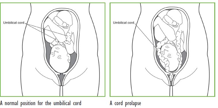 Umbilical cord prolapse in late pregnancy