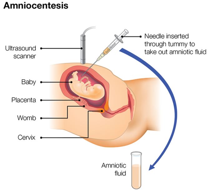 Screening in pregnancy: CVS and amniocentesis