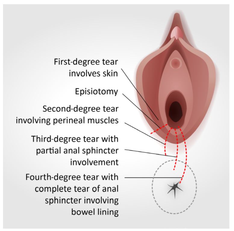 Care of a third- or fourth-degree tear that occurred during childbirth