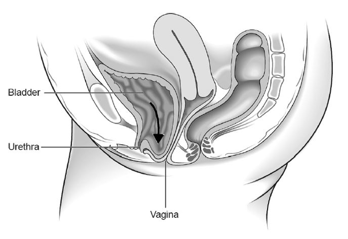 Pelvic organ prolapse