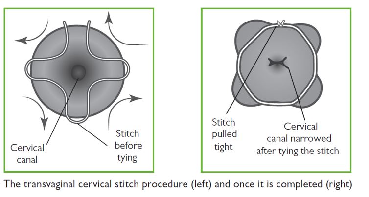 Cervical stitch