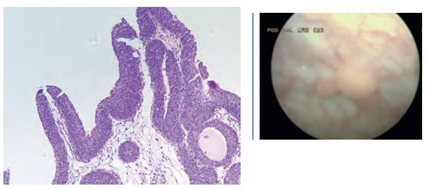 Genital herpes in pregnancy