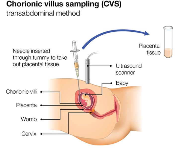Screening in pregnancy: CVS and amniocentesis