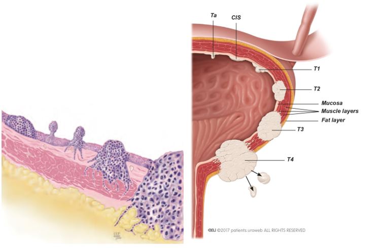 Genital herpes in pregnancy