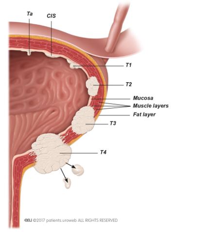 Genital herpes in pregnancy