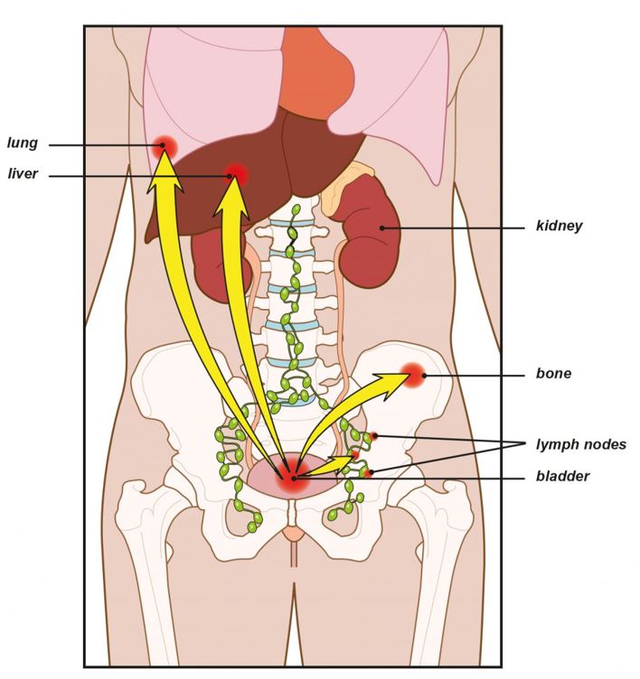 Genital herpes in pregnancy