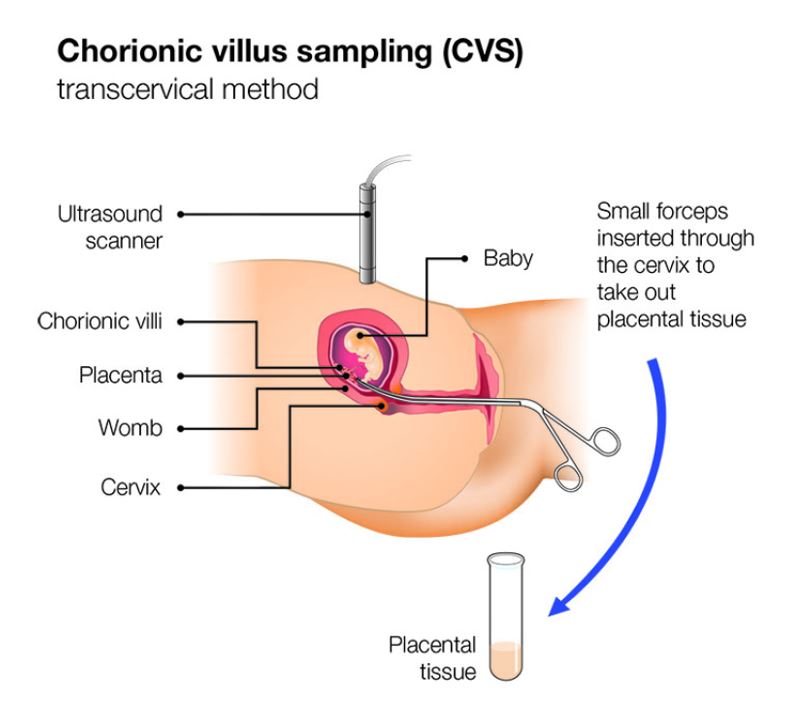 Screening in pregnancy: CVS and amniocentesis