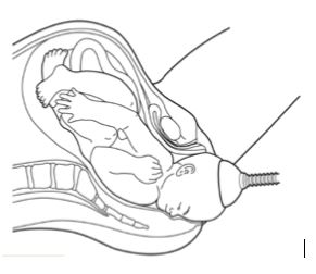 Assisted vaginal birth (ventouse or forceps)