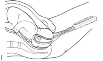 Assisted vaginal birth (ventouse or forceps)